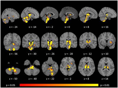 Occulomotor Neural Integrator Dysfunction in Multiple Sclerosis: Insights From Neuroimaging